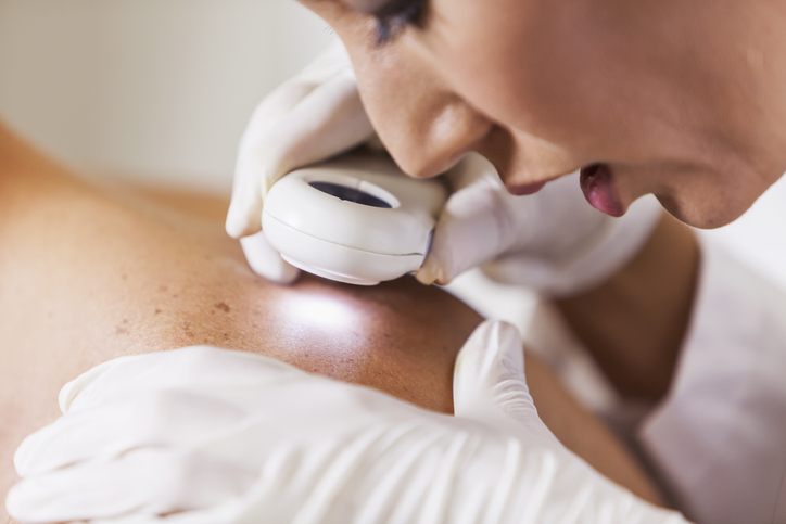 dermatologist examining a patient skin with a dermatoscope